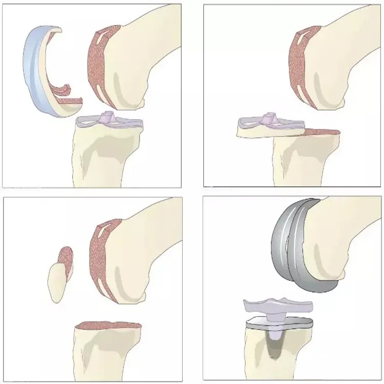 Top Quality Manufacturer Surgical Implants Primary Total Knee Prosthesis