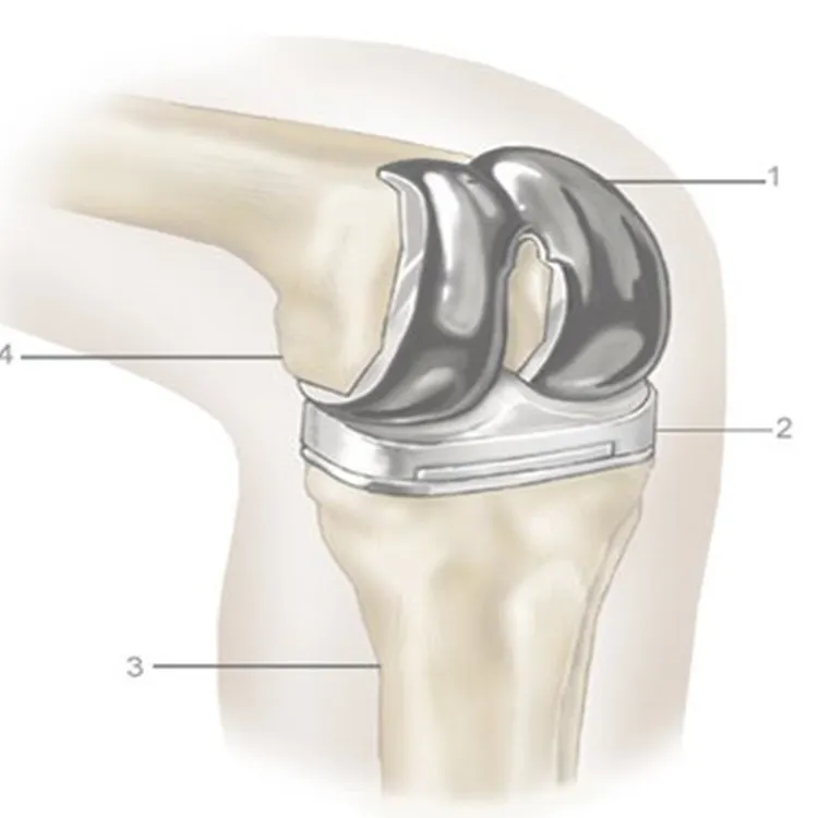 Top Quality Manufacturer Surgical Implants Primary Total Knee Prosthesis